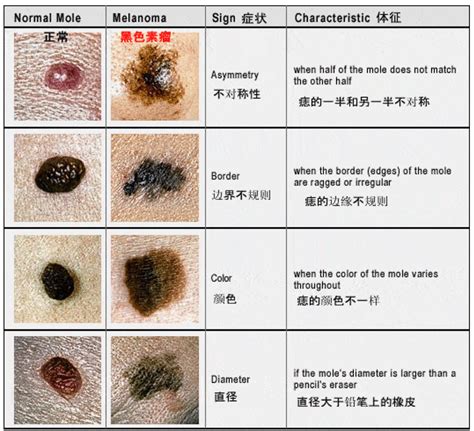 全身痣|你身上的痣会癌变吗？医生分析了100多颗黑痣，快来。